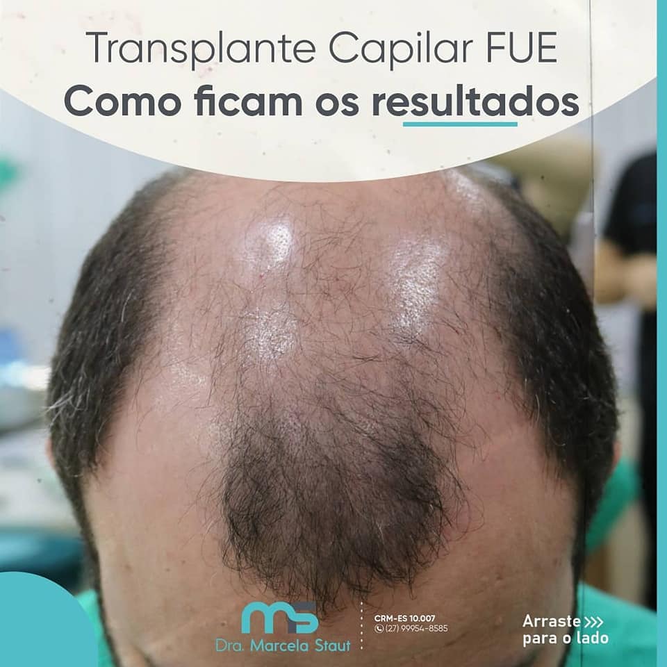 transplante capilar fue antes 1