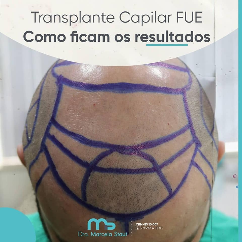 transplante capilar fue antes 2