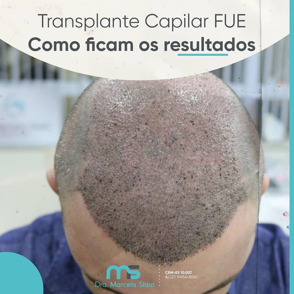 transplante capilar fue 2 depois