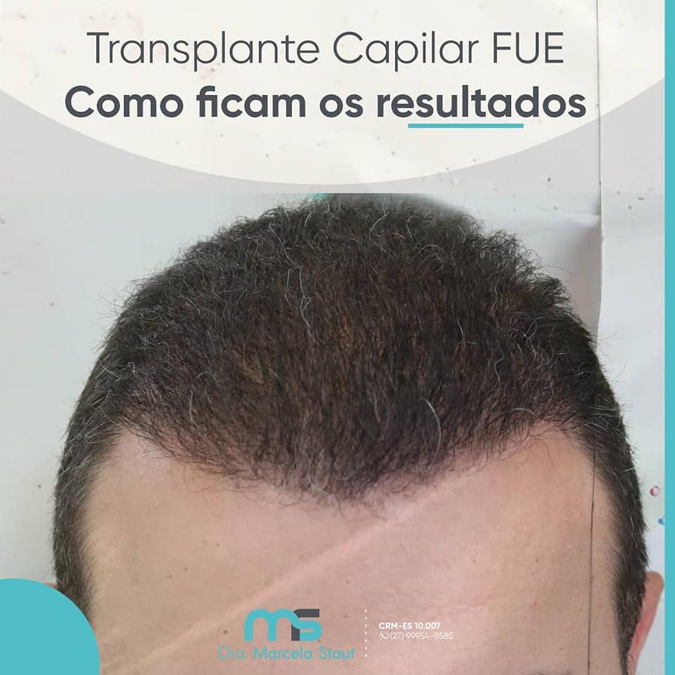 transplante capilar fue depois 2