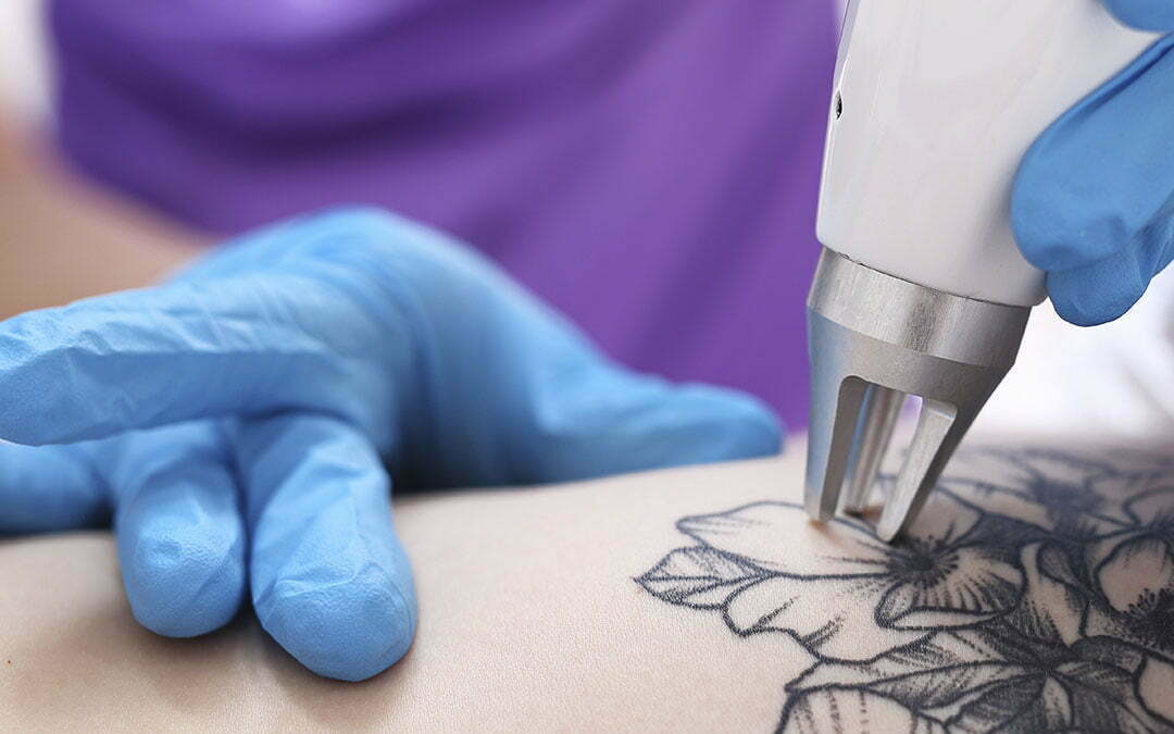 Servicos–Remoção de tatuagens